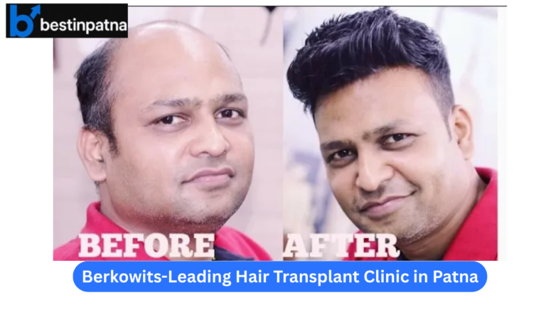 Berkowits RichFeel Hair & Skin Clinic – Leading Hair Transplant Clinic in Patna
