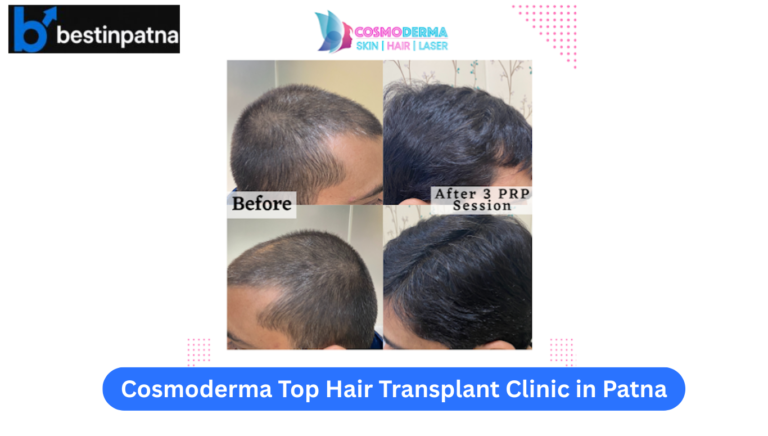 Cosmoderma – Skin | Hair | Laser – Top Hair Transplant & Dermatology Clinic in Patna