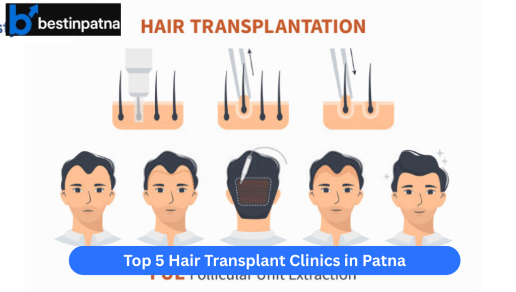 Top 5 Hair Transplant Clinics in Patna: Meet the Best Doctors & Know the Cost